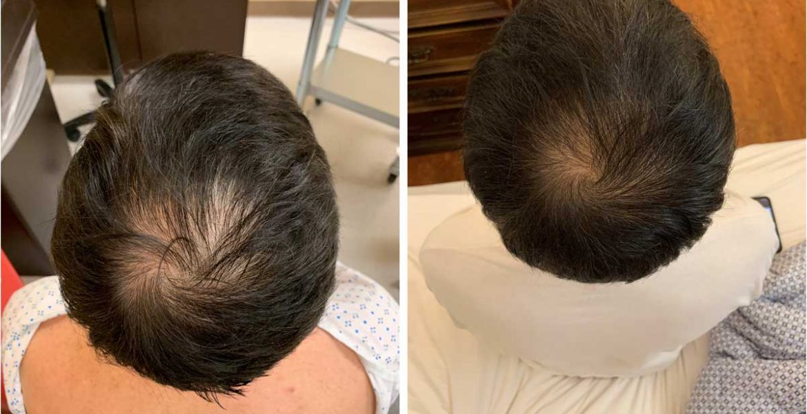 PRP Hair Treatment Results