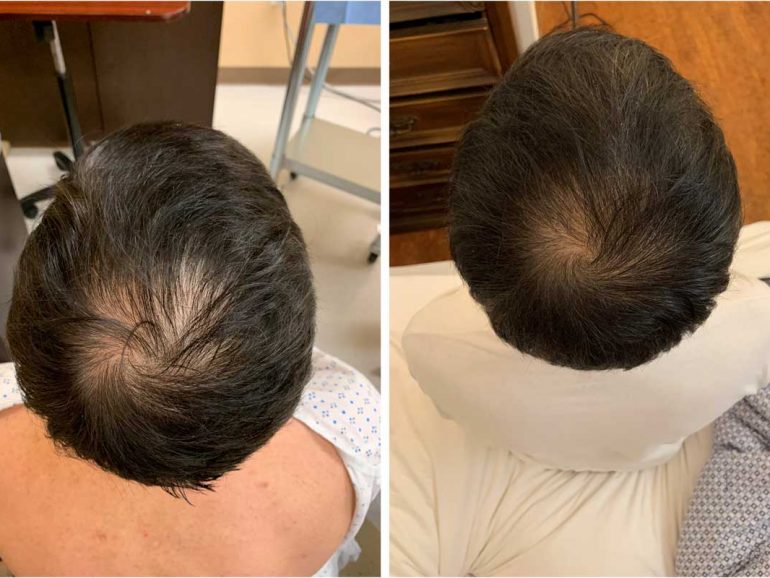PRP Hair Treatment Results
